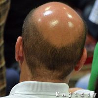 علت ریزش مو در مردان ایرانی چیست و راه حل اصلی آن چیست