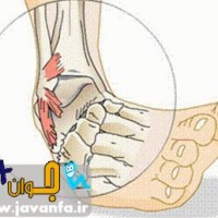 درمان رگ به رگ شدن و کبودی ها چگونه است ؟