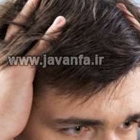 سوال و جواب در مورد ریزش مو
